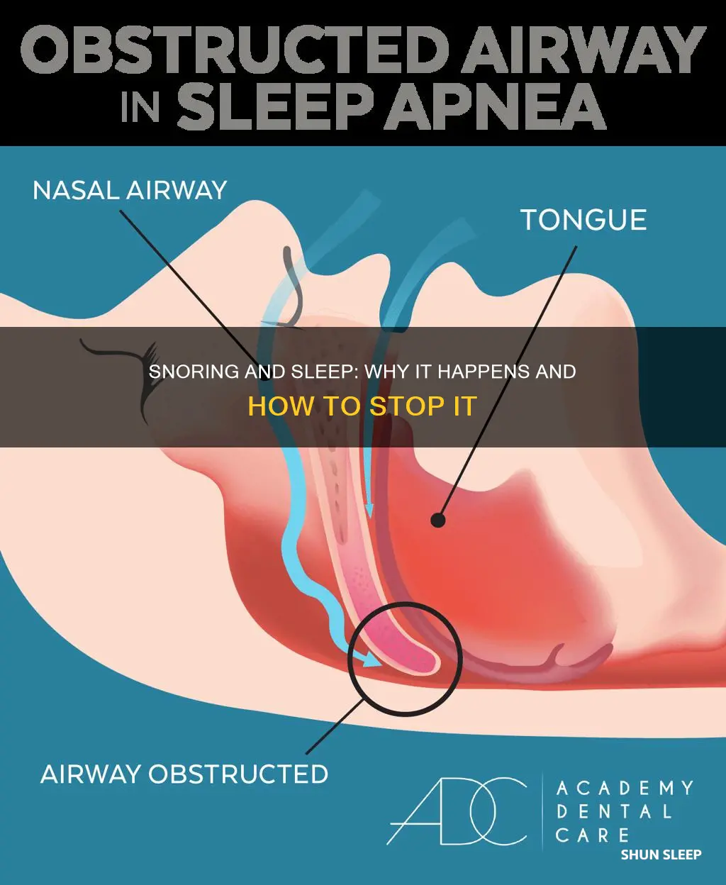 why snoring happens while sleeping