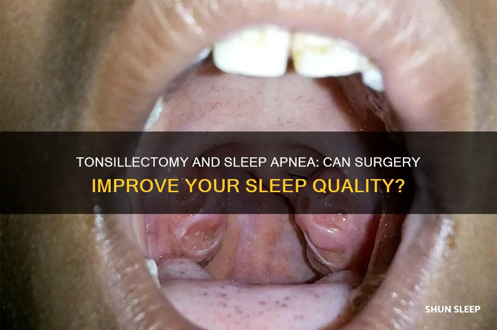 will a tonsillectomy help with sleep apnea