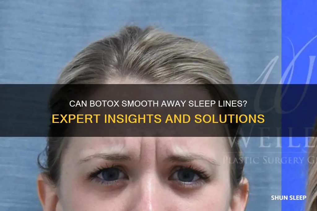 will botox get rid of sleep lines