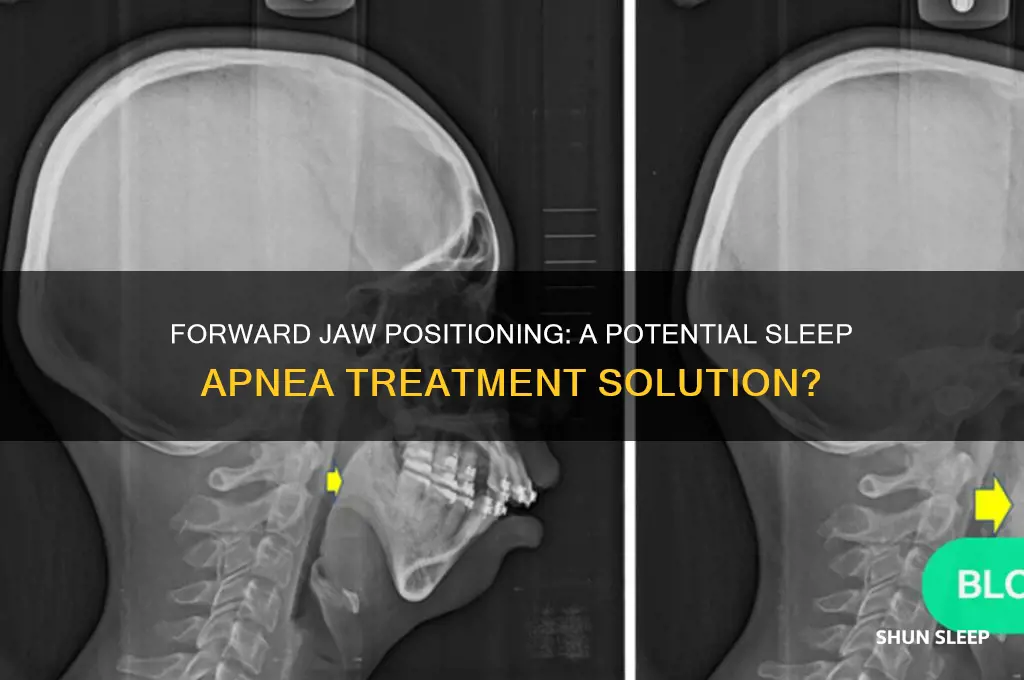will forward jaw help sleep apnea