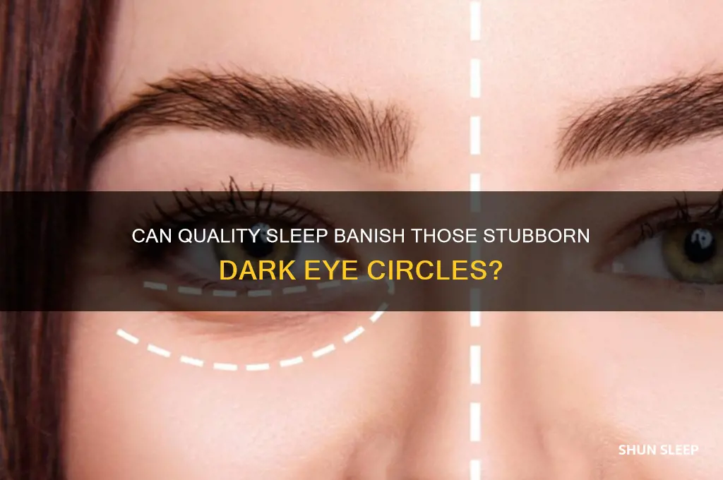 will getting sleep get rid of no sleeping eye circles