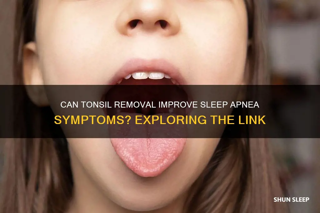 will removing tonsils help sleep apnea