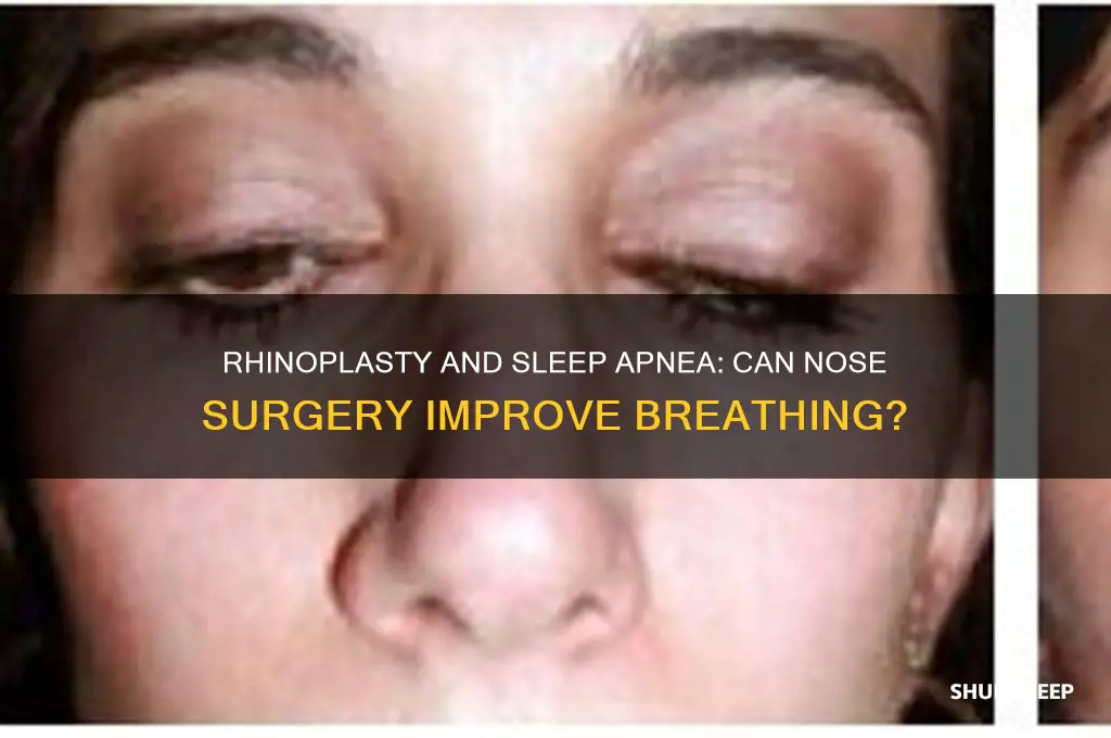 will rhinoplasty help sleep apnea