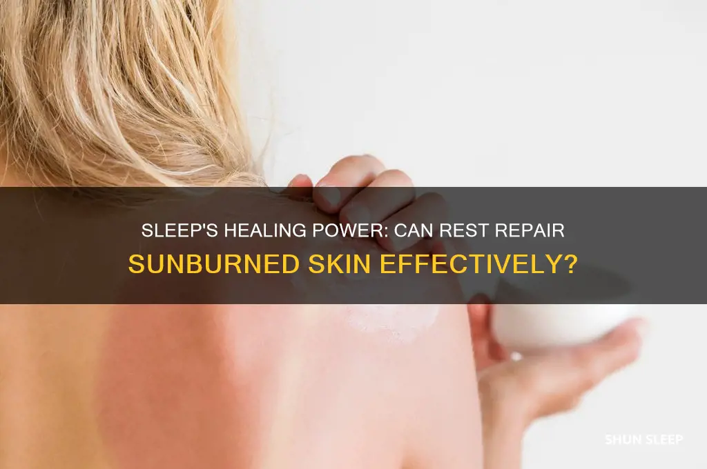will sleep help heal a sunburn