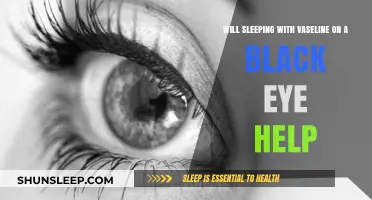 Does Vaseline Speed Up Black Eye Healing? Facts and Myths