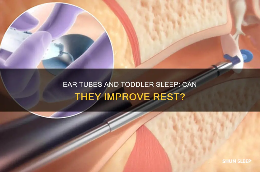 will toddlers sleep better after getting ear tubes
