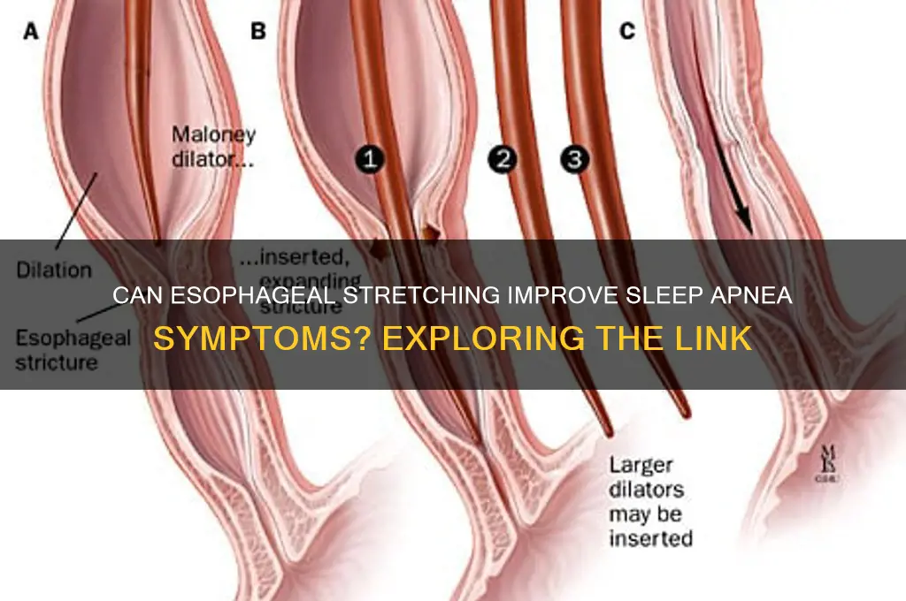 would stretching your esophagus help with sleep apnea